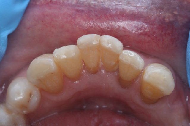 Incisal Bonding After